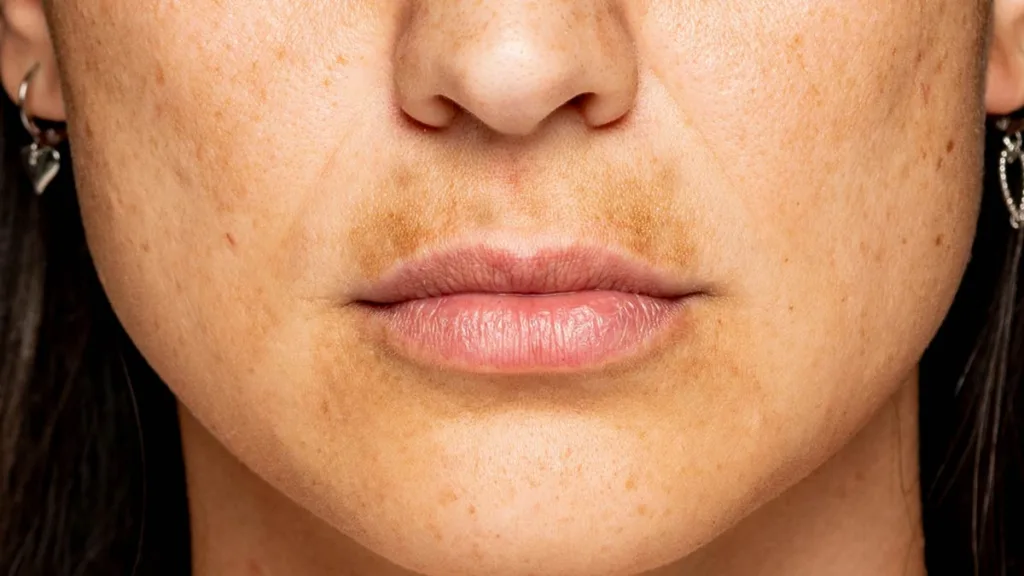 pigmentation-using-curd-at-home